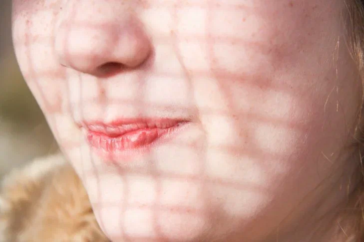 Врач рассказала, как спасти кожу лица зимой Кожа лица