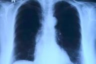 Туберкулез