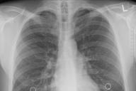 Российские ученые создали томограф для наблюдения за пациентами на ИВЛ