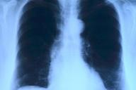 Снимок легких 
